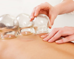 Cupping