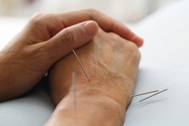 Have You Tried Acupuncture for Carpal Tunnel Syndrome?Wholeself Acupuncture